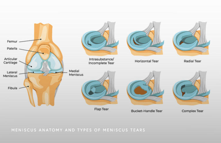 Meniscus Tear Schaumburg Thomas Obermeyer Md