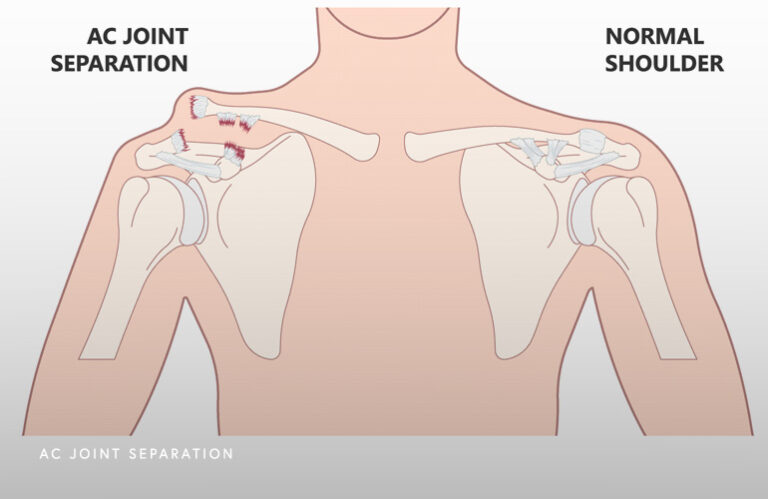 Ac Joint Conditions Schaumburg Thomas Obermeyer Md 0991