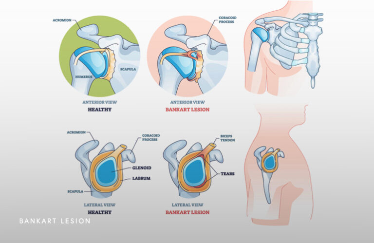 Torn Labrum After Dislocation Schaumburg IL Thomas Obermeyer MD