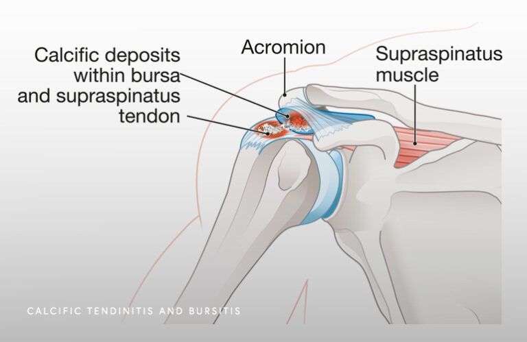 Calcific Tendonitis Schaumburg Thomas Obermeyer Md