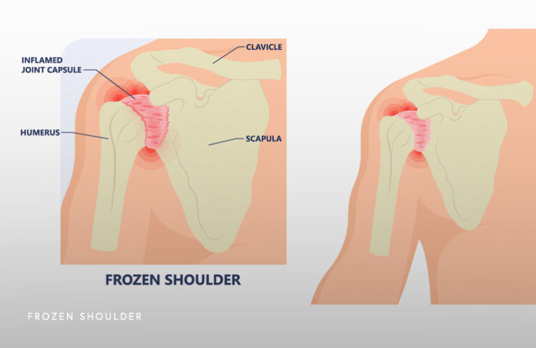 Frozen Shoulder Schaumburg Thomas Obermeyer Md