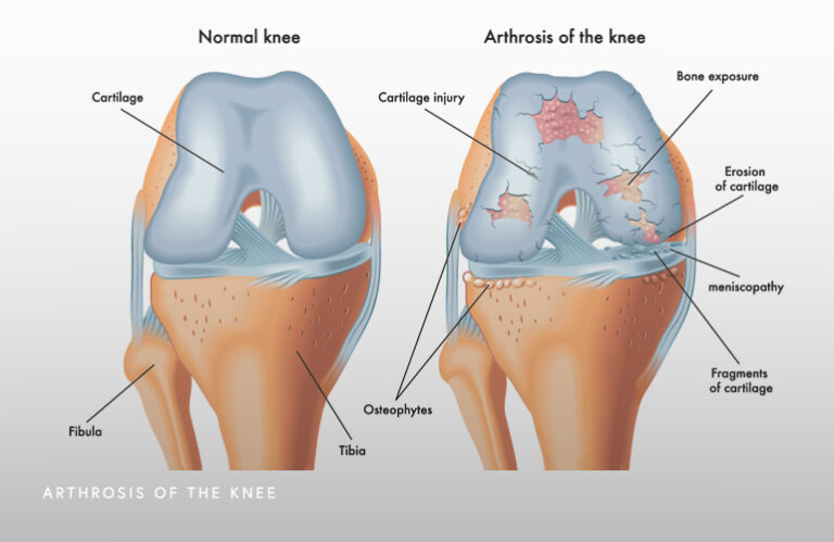 Knee Athritis Schaumburg Il Thomas Obermeyer Md 2743