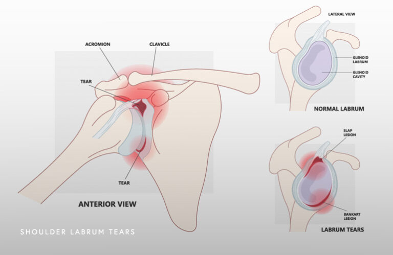 Slap Tear Schaumburg Thomas Obermeyer Md